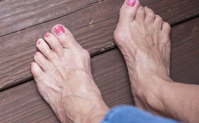 Can bunions recur even after they are operated upon?