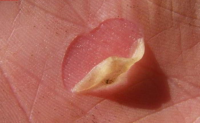 Can I burst the blister?
