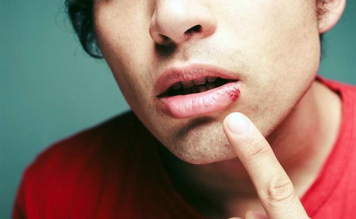 Can I get cold sores if I diet?