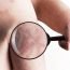 Can, psoriasis be affected by swimming?