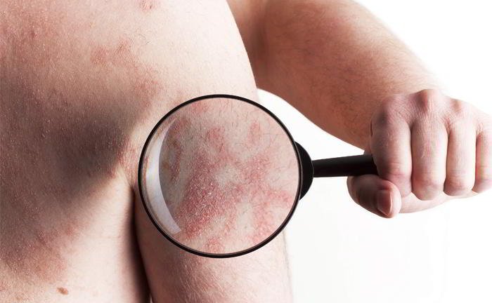 Can, psoriasis be affected by swimming?