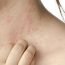 Can the change of water condition affect eczema?