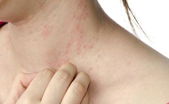 Can the change of water condition affect eczema?