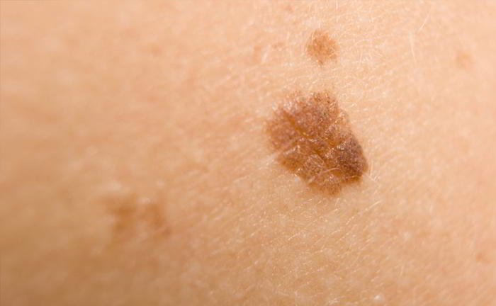 Do I need to worry because my mole seems to be growing bigger?