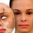 Home Remedies for Leucoderma Treatment