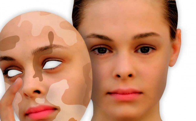 Home Remedies for Leucoderma Treatment