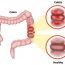 Homemade Remedies for Irritable Bowel Syndrome (IBS)