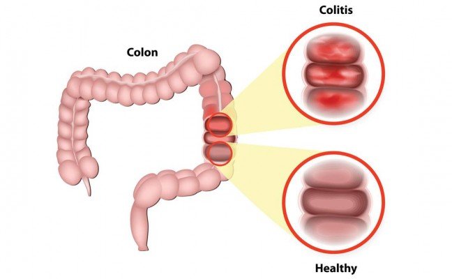 Homemade Remedies for Irritable Bowel Syndrome (IBS)