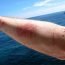 Homemade Remedies for Jellyfish Sting