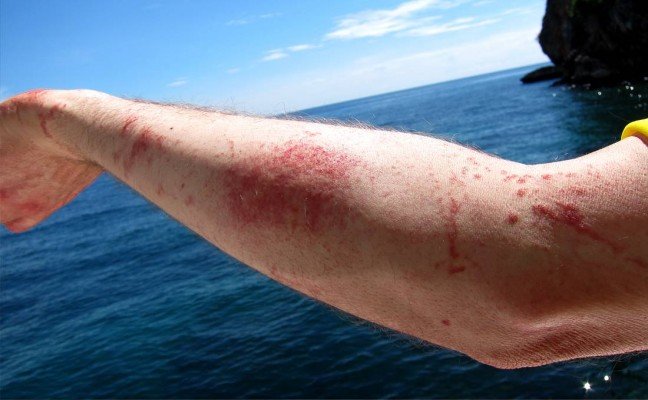 Homemade Remedies for Jellyfish Sting