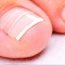 Homemade Remedies to Cure Ingrown Nail Naturally