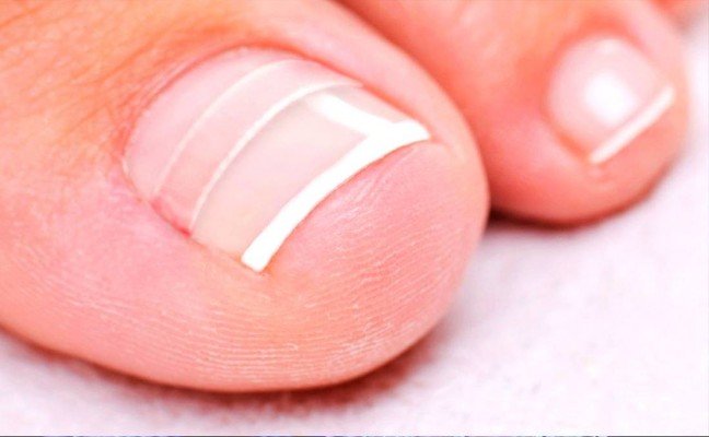 Homemade Remedies to Cure Ingrown Nail Naturally