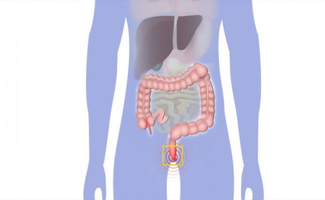 Homeopathic Medicines for Piles