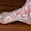 Homeopathic remedies for heat rashes