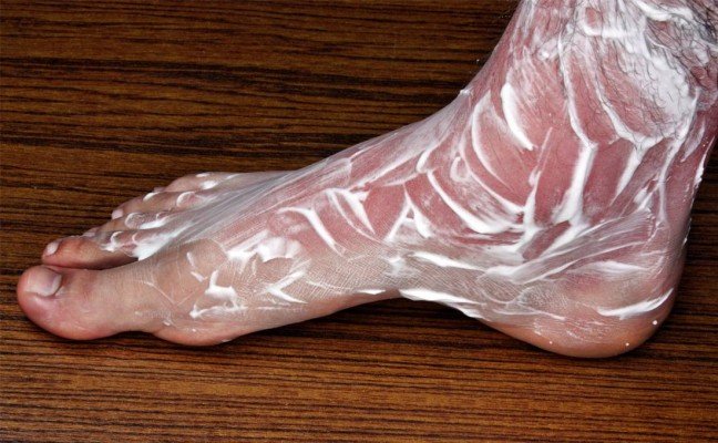 Homeopathic remedies for heat rashes