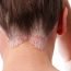 Homeopathic remedies for the treatment of psoriasi