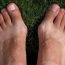 How are bunions caused?