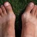 How are bunions caused?