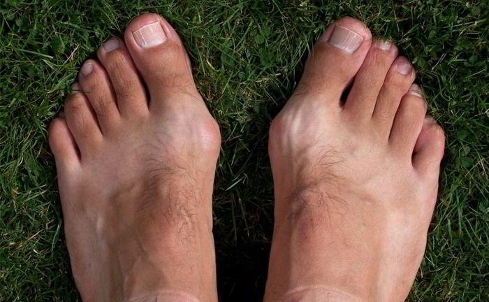 How are bunions caused?
