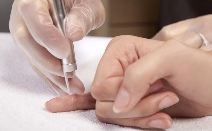 How are Warts caused and are they infectious?