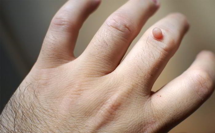 How are warts treated?