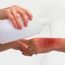 How can burn be treated?