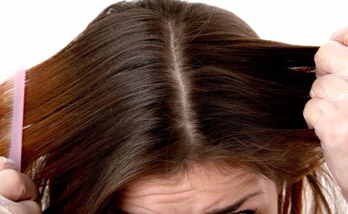 How can I get rid of dandruff?
