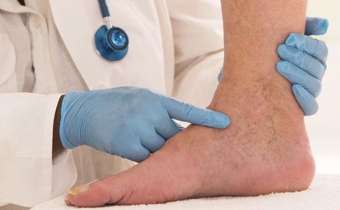 How can I prevent varicose veins?