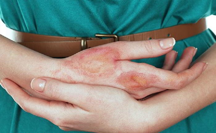 How can I take bath if my arm is fractured?