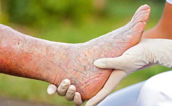 How can leg ulcer heal quickly?