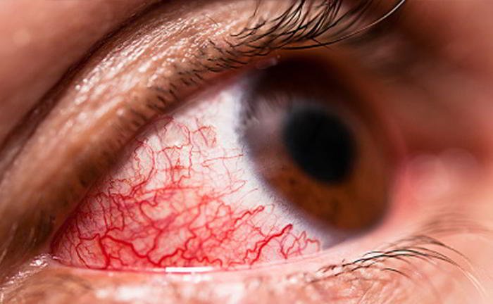 How can we prevent conjunctivitis?