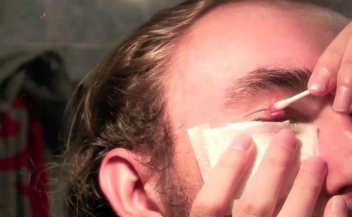 How can we treat a stye?