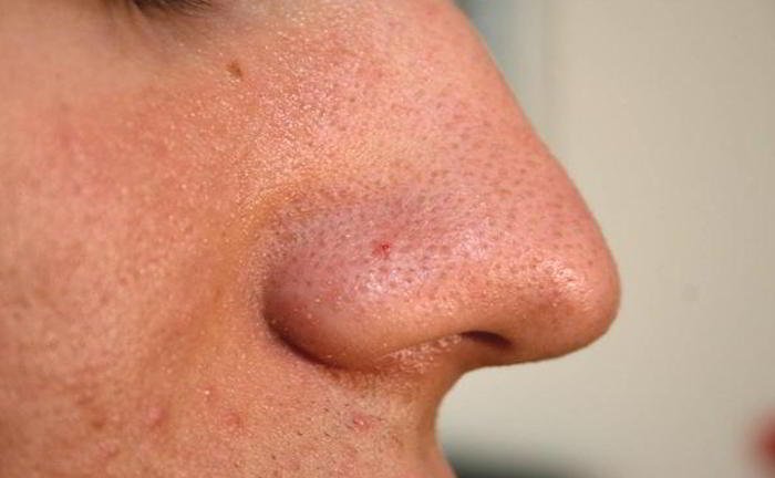 How can whiteheads be treated?