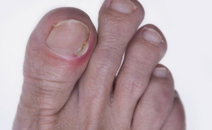 How does an ingrowing toenail occur?