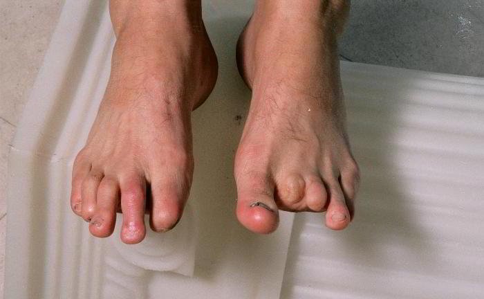 How is gangrene cured?