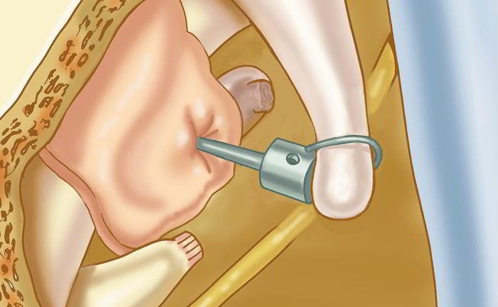 How is otosclerosis?