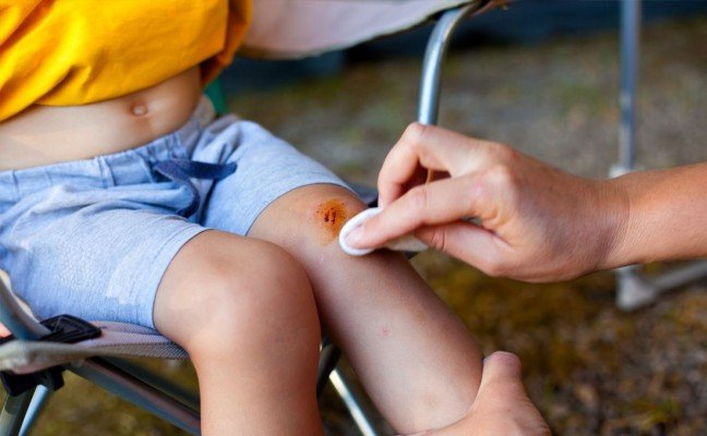 How to Cure Abrasions at Home Naturally?