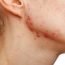 How to Cure Acne Scars at Home Naturally?
