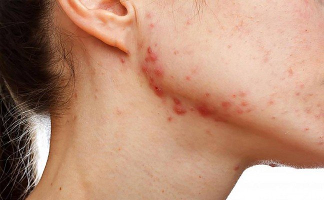 How to Cure Acne Scars at Home Naturally?