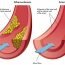 How to Cure Arteriosclerosis at Home Naturally?