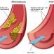 How to Cure Arteriosclerosis at Home Naturally?