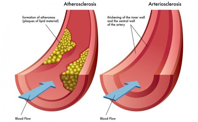 How to Cure Arteriosclerosis at Home Naturally?