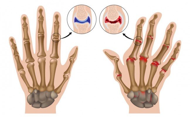 How to Cure Arthritis at Home Naturally?