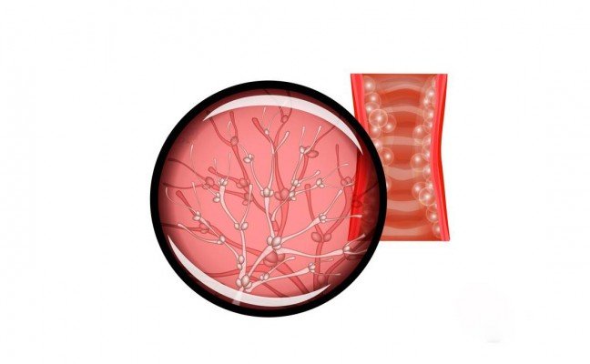 How to Cure Bacterial Vaginitis at Home Naturally?