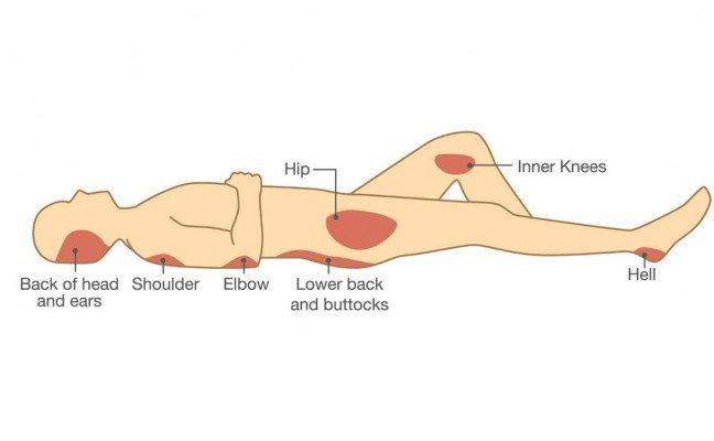 How to Cure Bed Sores at Home Naturally?