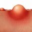 How to Cure Boils at Home Naturally?