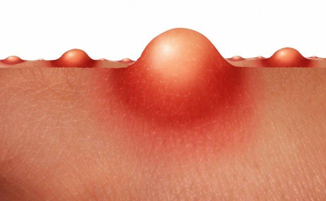 How to Cure Boils at Home Naturally?