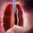 How to Cure Bronchitis at Home Naturally?