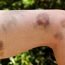 How to Cure Bruises at Home Naturally?