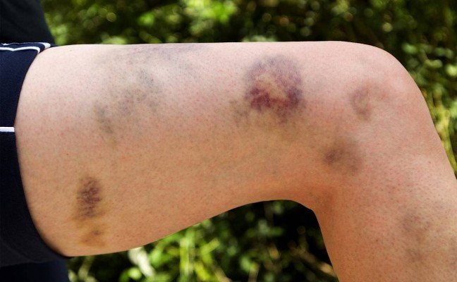 How to Cure Bruises at Home Naturally?